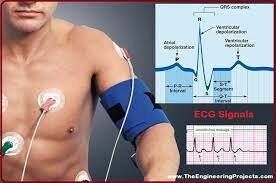 ECG