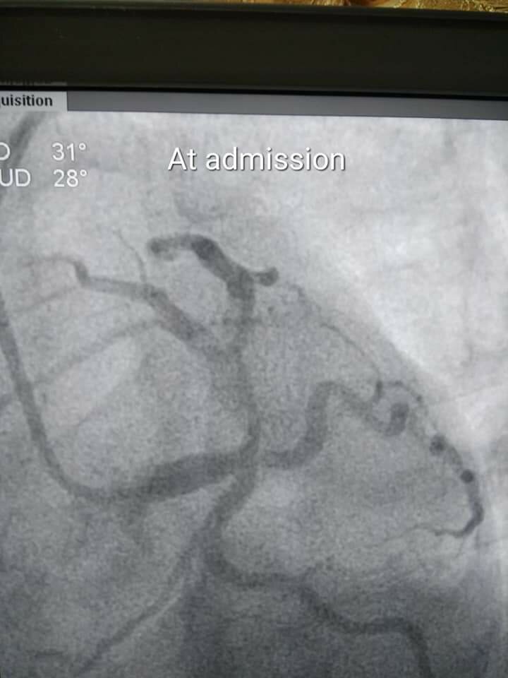 Blocked young heart and Doctor Yogesh|Jamage Heart Centre|Shivaji Road,Miraj